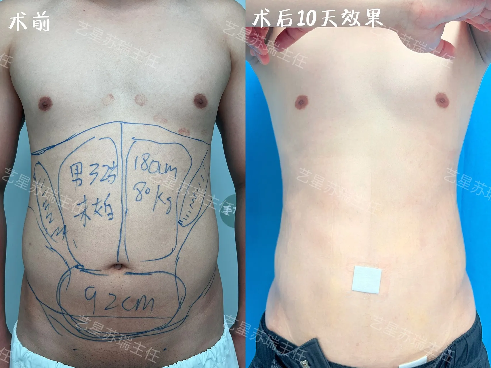 抽脂專科 case