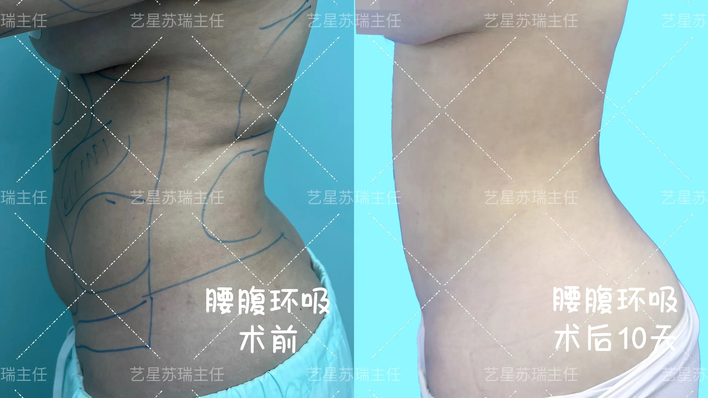 抽脂專科 case