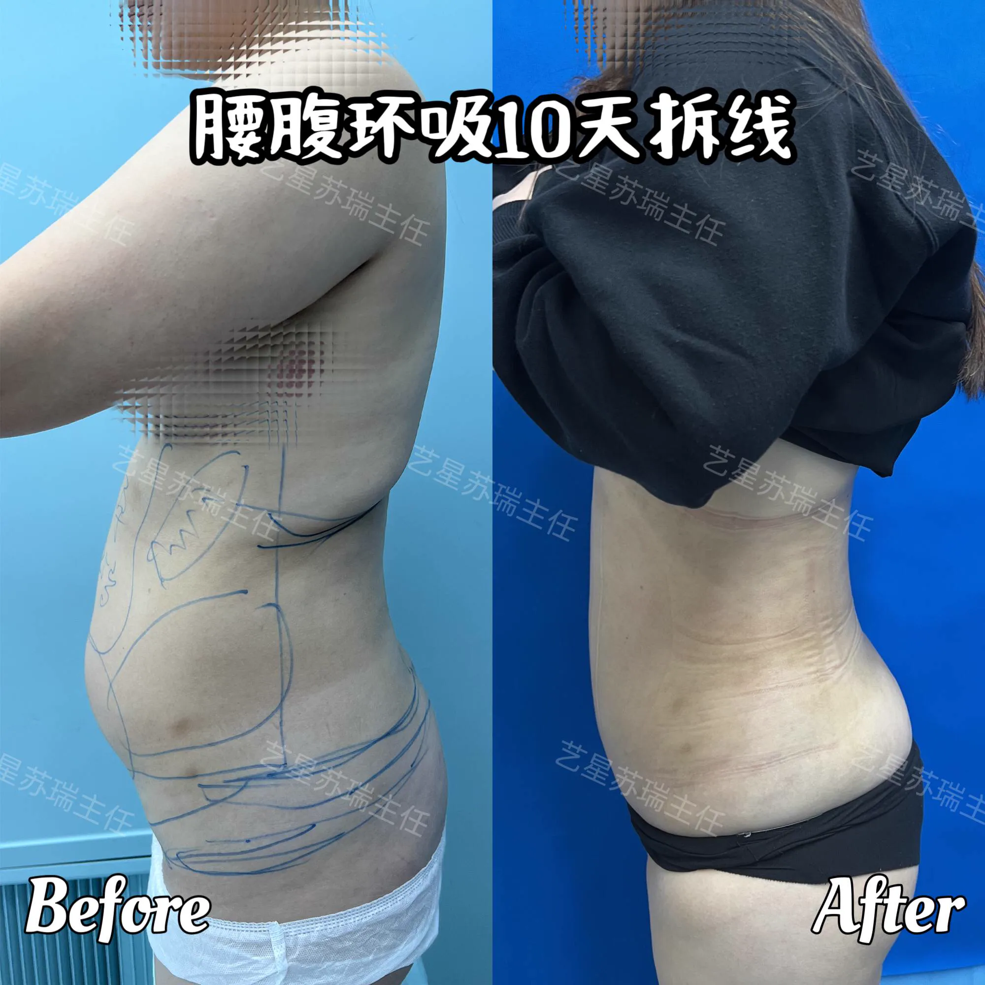 抽脂專科 case