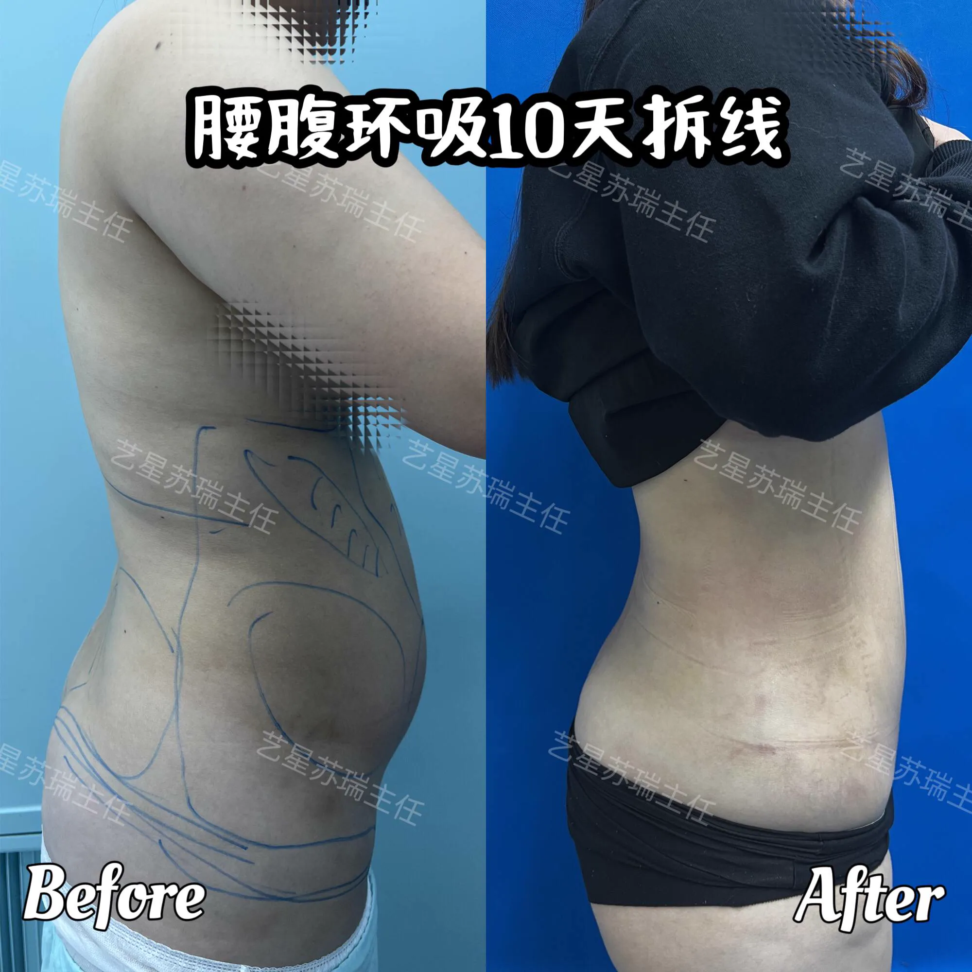 抽脂專科 case