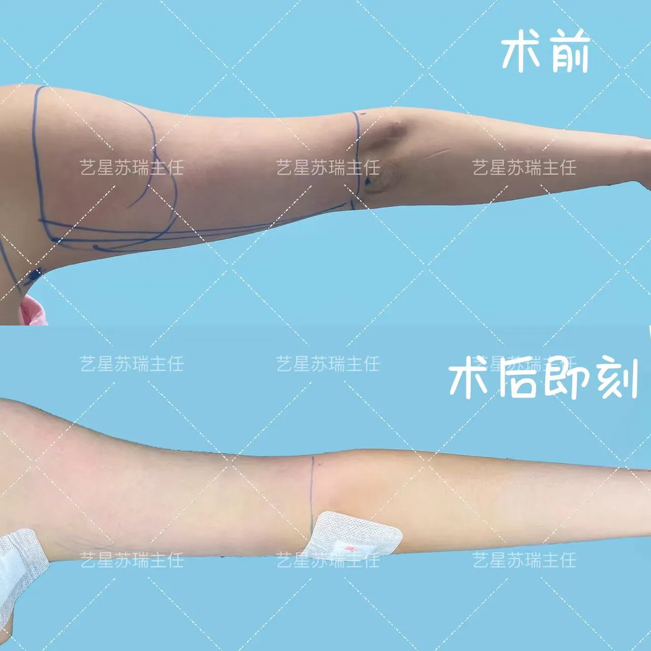 抽脂專科 case