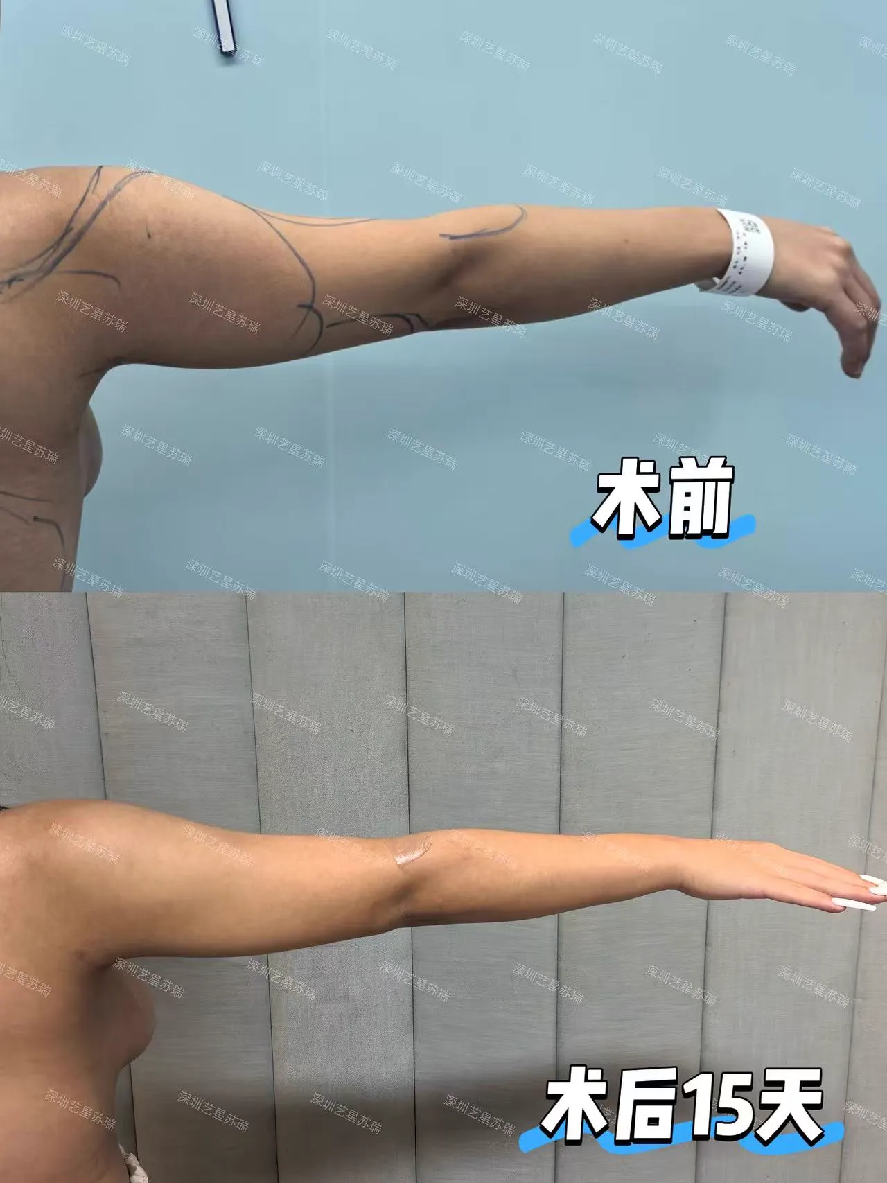 抽脂專科 case