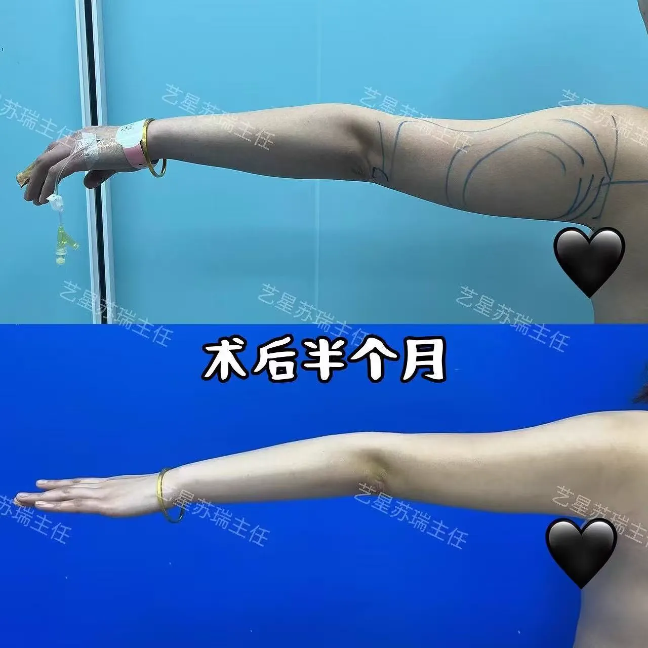 抽脂專科 case