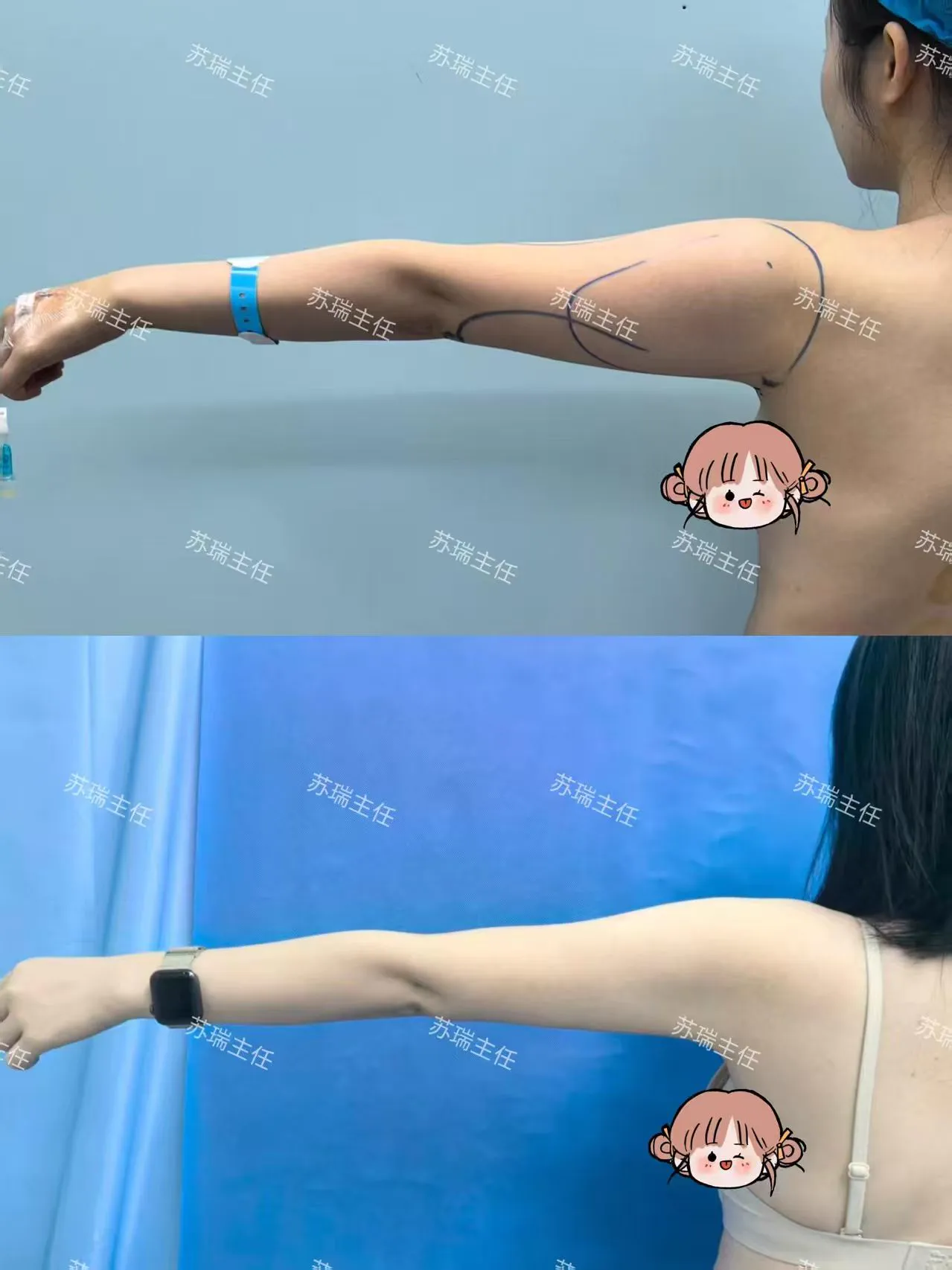 抽脂專科 case