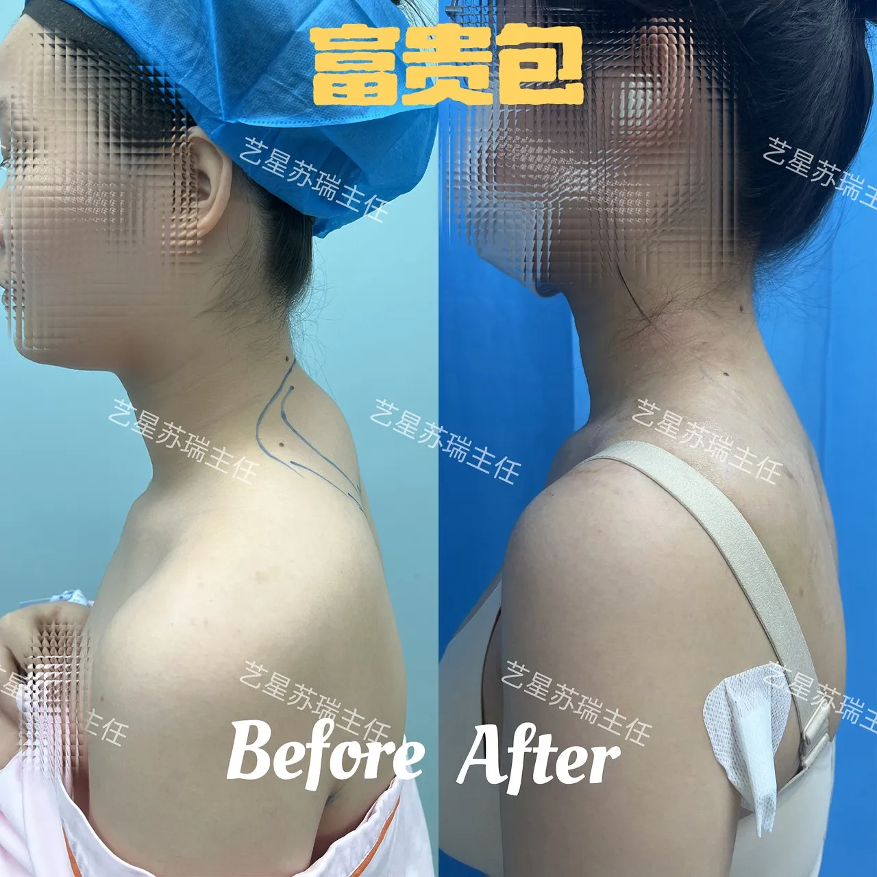抽脂專科 case