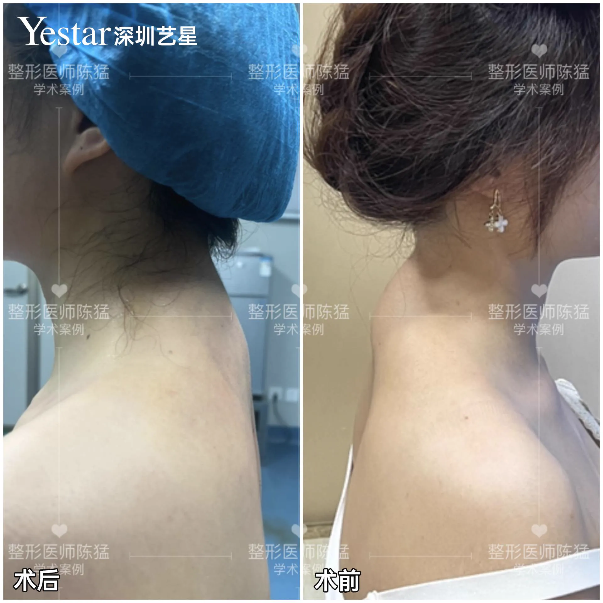 抽脂專科 case