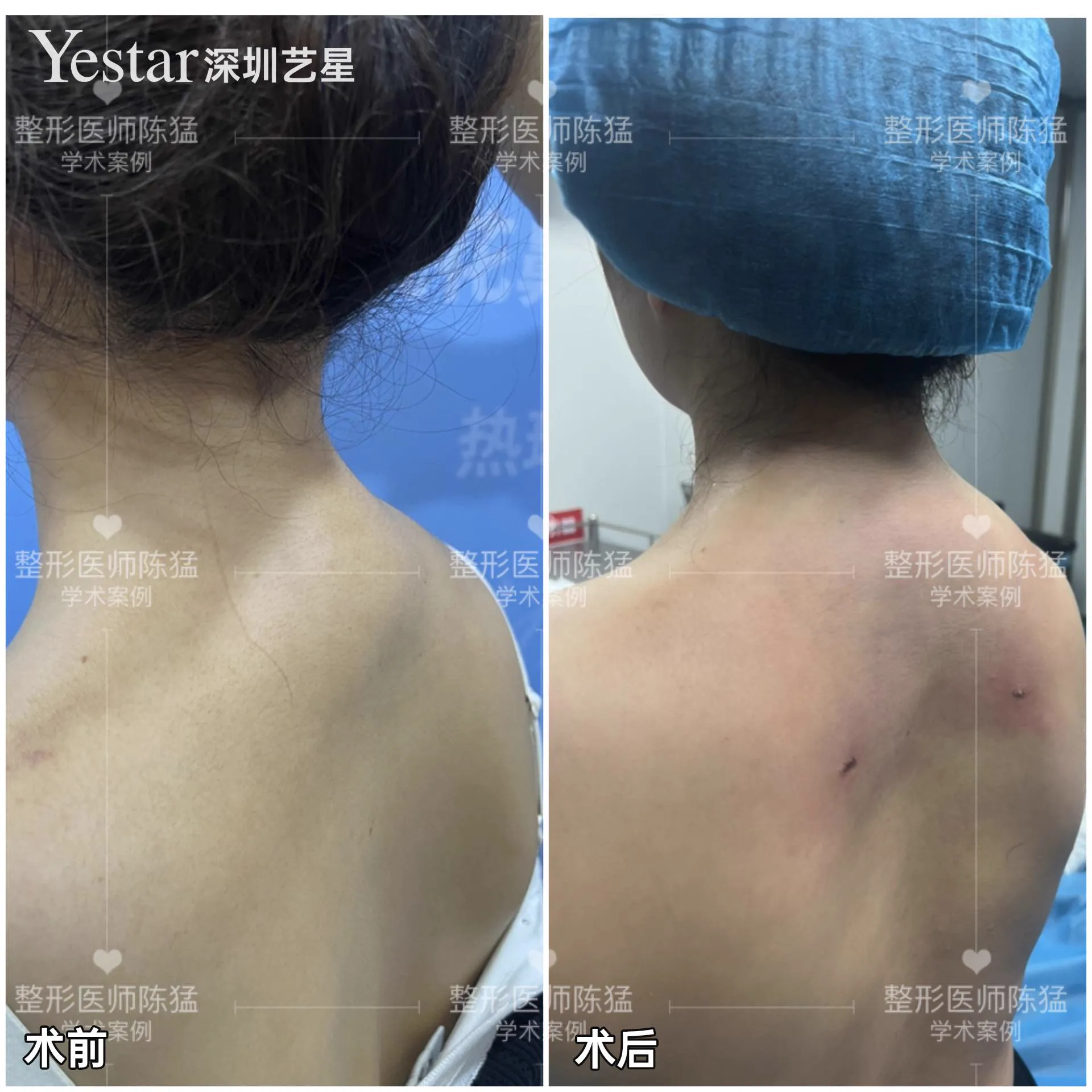 抽脂專科 case