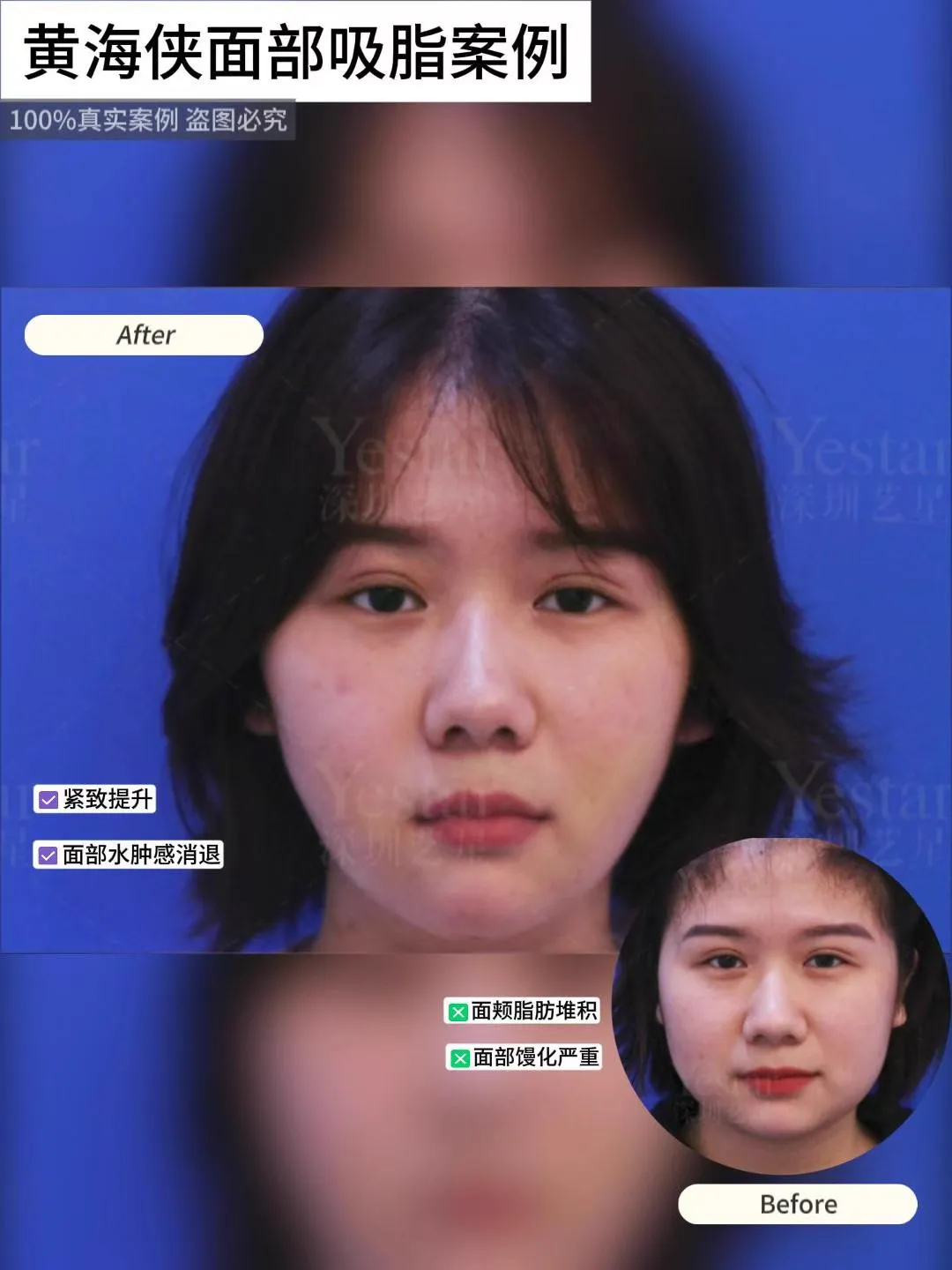 抽脂專科 case