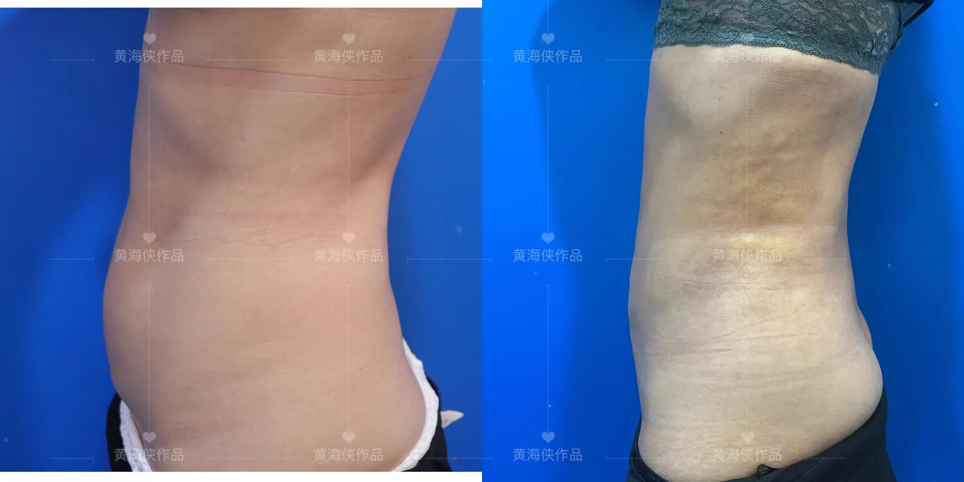抽脂專科 case