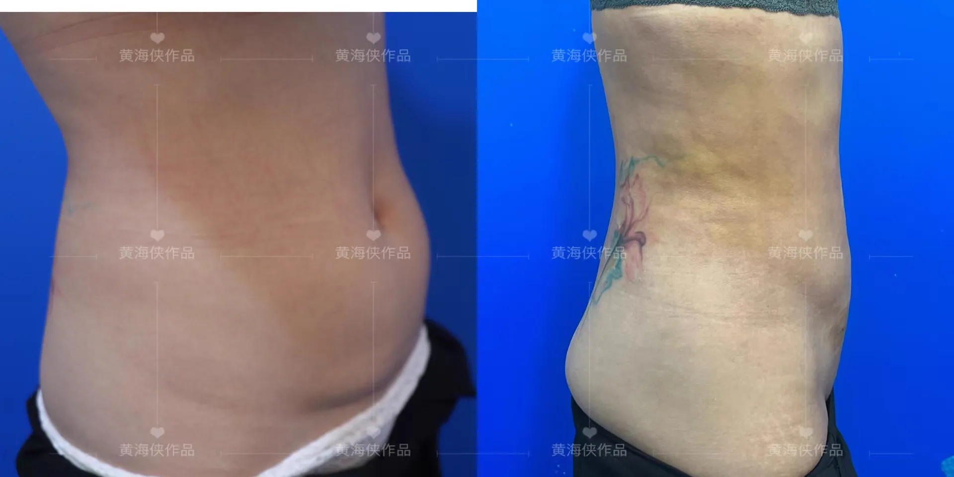 抽脂專科 case