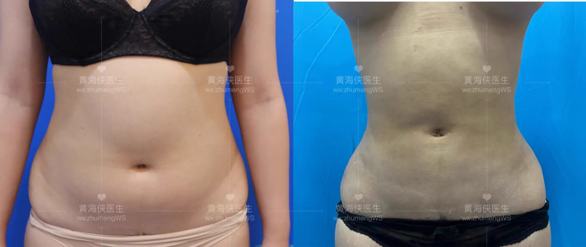 抽脂專科 case