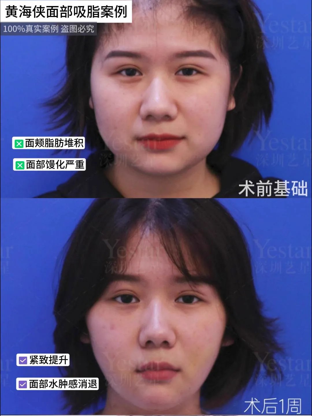 抽脂專科 case