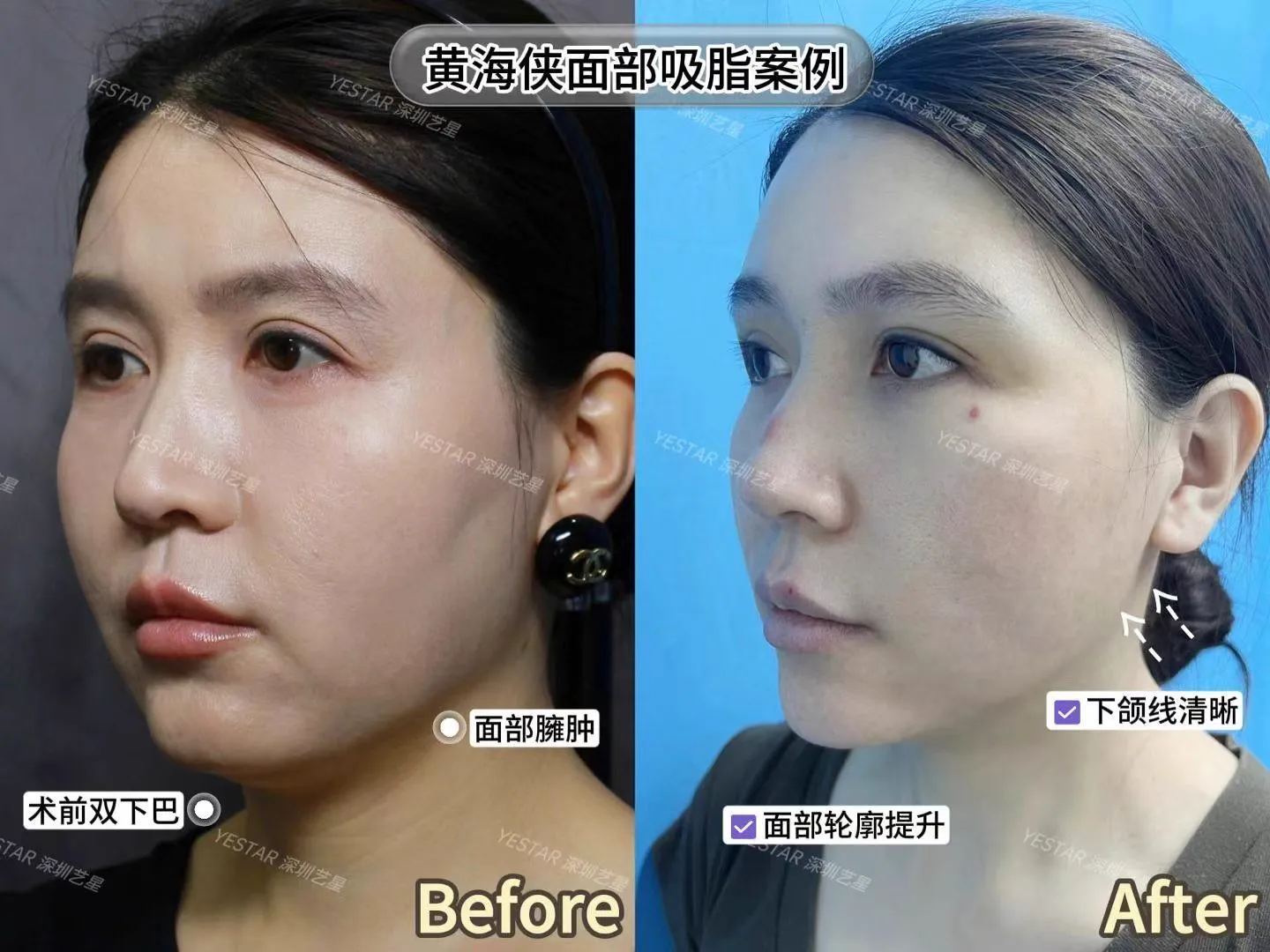 抽脂專科 case