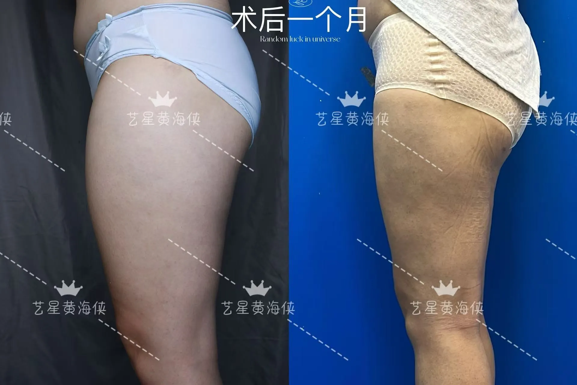 抽脂專科 case