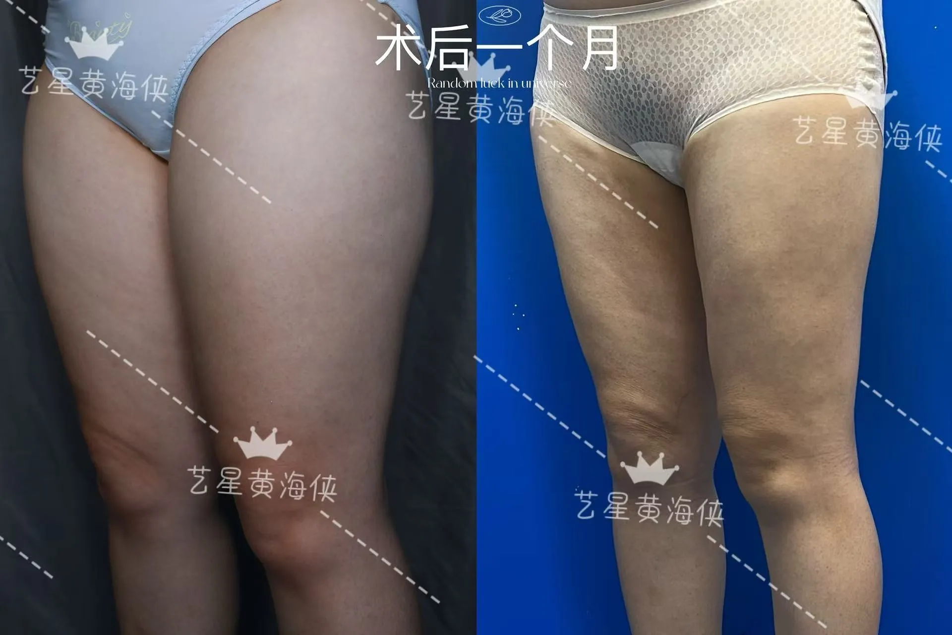 抽脂專科 case