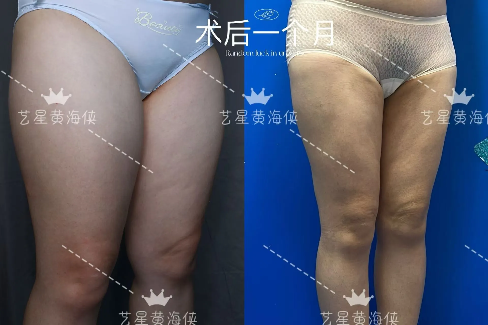 抽脂專科 case