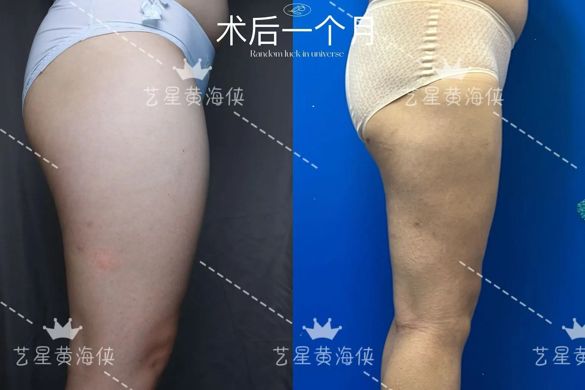 抽脂專科 case