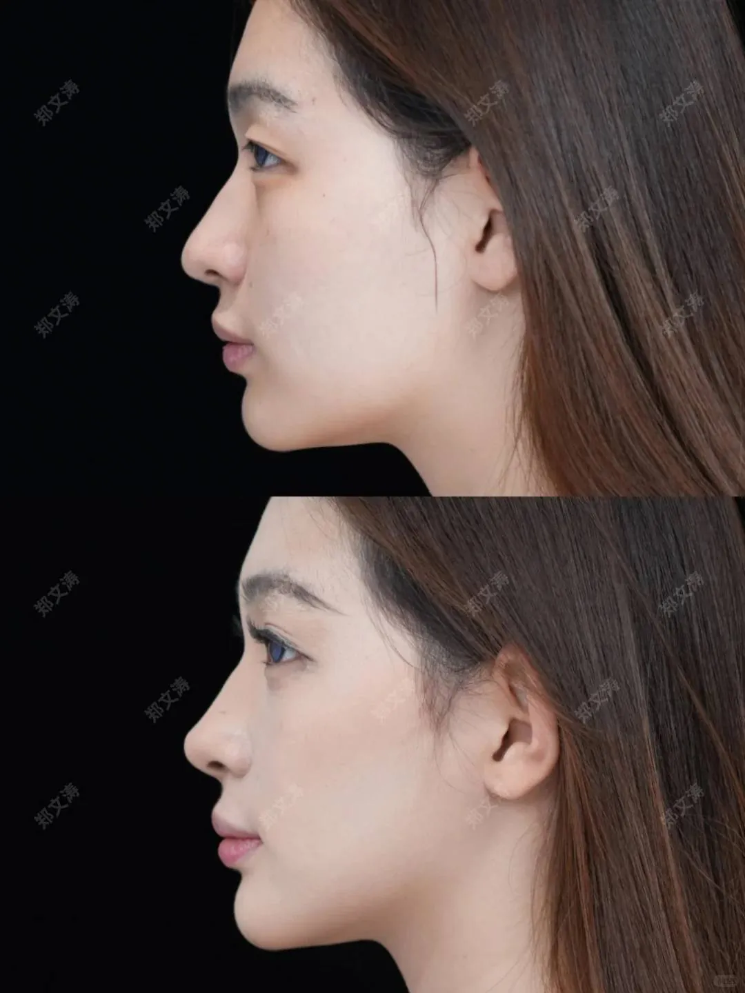 鼻部專科 case